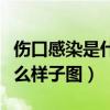伤口感染是什么样子图片真实(伤口感染是什么样子图) 伤口感染是什么样子图片真实(伤口感染是什么样子图)