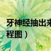 牙神经抽出来的过程图片（牙神经抽出来的过程图）