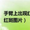 手臂上出现红色斑块是什么原因（手臂上出现红斑图片）