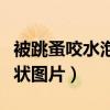 被跳蚤咬水泡症状图片大全（被跳蚤咬水泡症状图片）