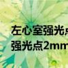 左心室强光点2mm严重吗能治好吗（左心室强光点2mm严重吗）