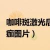 咖啡斑激光后多久可以恢复（咖啡斑激光后结痂图片）
