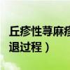 丘疹性荨麻疹消退过程水泡（丘疹性荨麻疹消退过程）