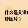 什么是艾滋病红斑样皮疹?（艾滋病红斑样皮疹图片）