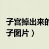 子宫掉出来的样子图片真实（子宫掉出来的样子图片）