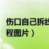 伤口自己拆线教程图片视频（伤口自己拆线教程图片）