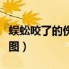 蜈蚣咬了的伤口图片图（蜈蚣咬了伤口的样子图）