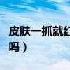 皮肤一抓就红是过敏吗（皮肤一抓就红是湿气吗）