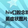 hiv口腔念珠菌症状图片女性（hiv口腔念珠菌症状图片）