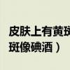 皮肤上有黄斑像碘酒是艾滋病吗（皮肤上有黄斑像碘酒）