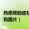 热疙瘩的症状和图片用什么药（热疙瘩的症状和图片）