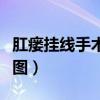 肛瘘挂线手术原理图视频（肛瘘挂线手术原理图）