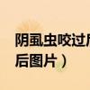 阴虱虫咬过后的伤口是什么样的?（阴虱虫咬后图片）