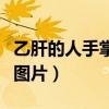 乙肝的人手掌心很红有问题吗（乙肝手掌发红图片）