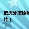 把虎牙拔掉嘴唇会歪吗（拔虎牙后嘴巴塌陷照片）