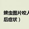 蜱虫图片咬人后图片如何处理（蜱虫图片咬人后症状）