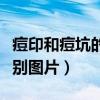 痘印和痘坑的区别图片对比（痘印和痘坑的区别图片）