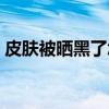 皮肤被晒黑了怎么快速变白（怎么快速变白）