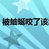 被蚰蜒咬了该怎么办（被蚰蜒咬了症状图片）