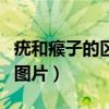 疣和瘊子的区别图片扁平疣（疣和瘊子的区别图片）