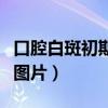 口腔白斑初期症状图片舌（口腔白斑初期症状图片）