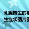 乳腺增生的症状表现乳腺增生的照片（乳腺增生症状图片图）