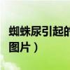 蜘蛛尿引起的水泡图片集（蜘蛛尿引起的水泡图片）