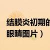 结膜炎初期的眼睛图片角膜炎（结膜炎初期的眼睛图片）
