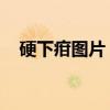 硬下疳图片 自我鉴定（硬下钳初期照片）