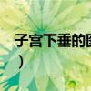子宫下垂的图片 症状 运动(子宫下垂的图片) 子宫下垂的图片 症状 运动(子宫下垂的图片)