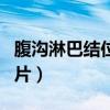 腹沟淋巴结位置图片女性（腹沟淋巴结位置图片）