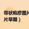 带状疱疹图片早期症状照片腰部（带状疱疹图片早期）