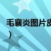 毛襄炎图片皮肤头上怎么治（毛襄炎图片皮肤）