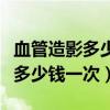 血管造影多少钱一次报销后能报销(血管造影多少钱一次) 血管造影多少钱一次报销后能报销(血管造影多少钱一次)