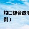 灼口综合症治愈案例视频（灼口综合症治愈案例）