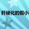 肝硬化的假小叶绘图（肝硬化假小叶手绘图）