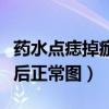 药水点痣掉痂后正常图片大全（药水点痣掉痂后正常图）
