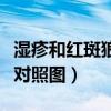 湿疹和红斑狼疮对照图湿疹（湿疹和红斑狼疮对照图）