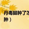丹毒脚肿了怎么快速消肿（脚肿了怎么快速消肿）