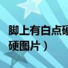 脚上有白点硬硬的不痒有凸起（脚上起白点发硬图片）