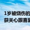 1岁被烧伤的女孩学化妆是想有眉毛 拍视频收获关心跟喜爱