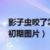 影子虫咬了怎么办会自己痊愈?（影子虫咬伤初期图片）