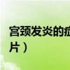 宫颈发炎的症状图片大全（宫颈发炎的症状图片）